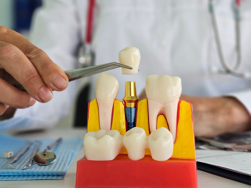 Digital implant workflow: precision and efficiency