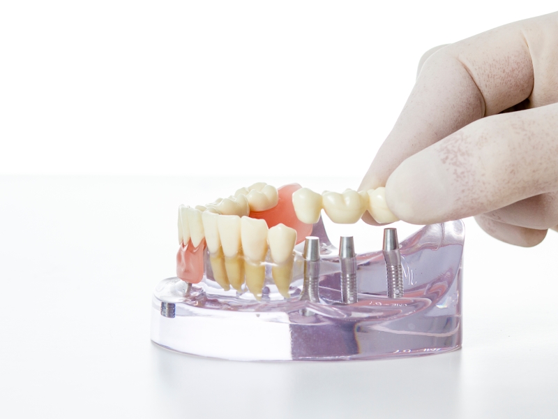 Digital workflow CAD libraries as an as a key advancement in modern dentistry